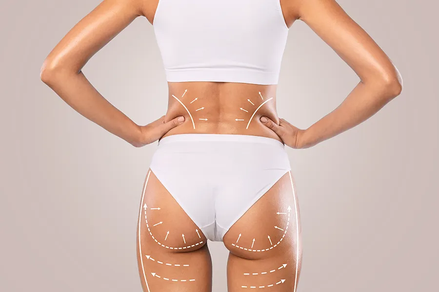 EMSculpt-Butt-Lift-Clinic A woman's rear with lines denoting areas to tone. Get an EMSculpt® Butt Lift from Healthy Aging Medical Centers of New Jersey in Northern New Jersey.