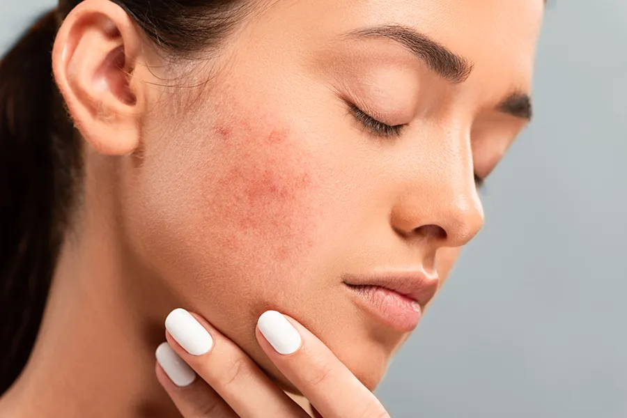 Radiofrequency-Microneedling-for-Acne-Clinic A woman with acne. Schedule Radiofrequency Microneedling for Acne Scars Treatment from Healthy Aging Medical Centers of New Jersey in Northern New Jersey.