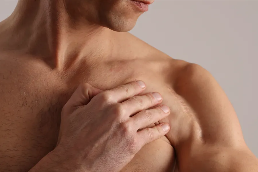 Radiofrequency-Microneedling-for-Scars-Clinic A scar running across a man's shoulder. Schedule Radiofrequency Microneedling for Scars Treatment from Healthy Aging Medical Centers of New Jersey in Northern New Jersey.