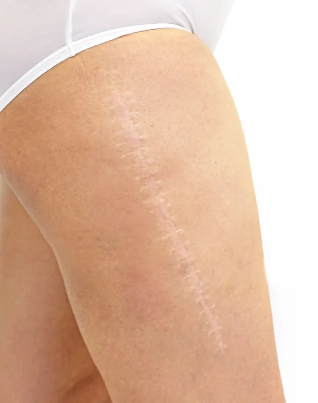 Radiofrequency-Microneedling-for-Scars-Treatment A scar running down a woman's leg. Get Radiofrequency Microneedling for Scars Treatment from Healthy Aging Medical Centers of New Jersey in Northern New Jersey.