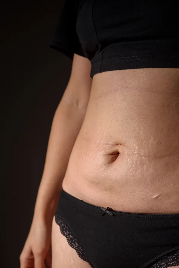 Radiofrequency-Microneedling-for-Stretch-Marks-Treatment A woman with stretch marks on her belly. Get Radiofrequency Microneedling for Stretch Marks Treatment from Healthy Aging Medical Centers of New Jersey in Northern New Jersey.